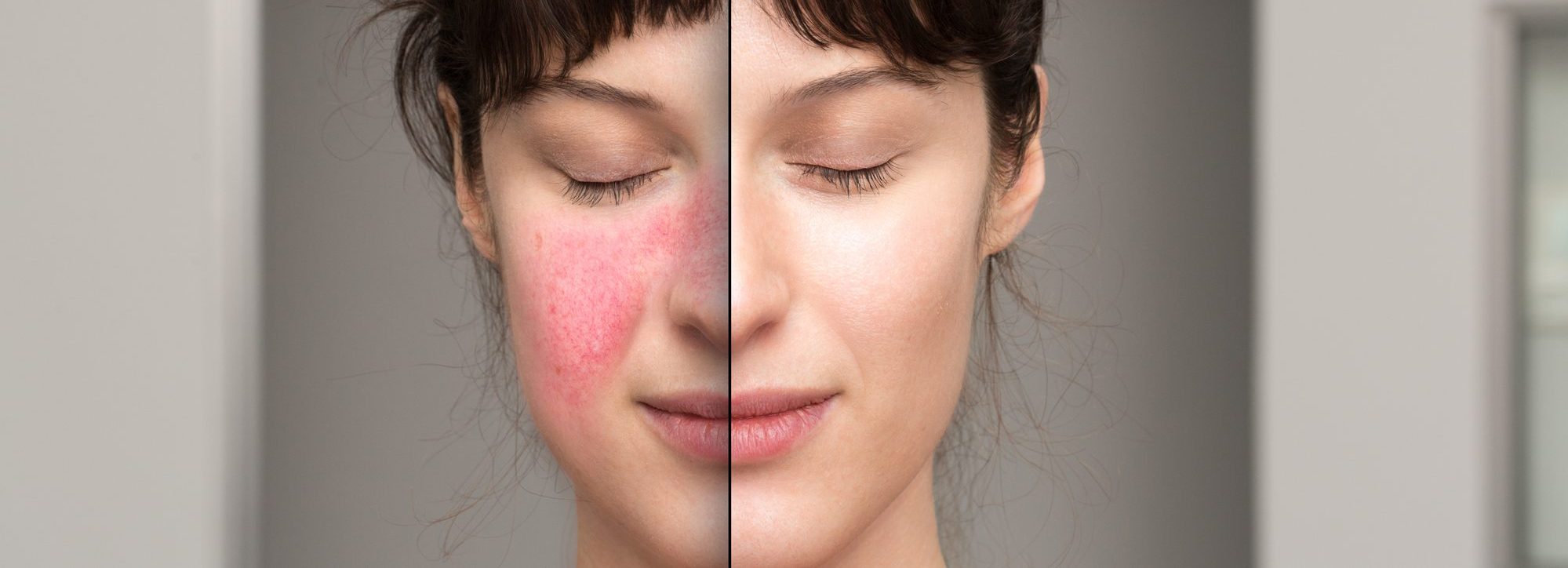 rosacea: before and after the cosmetic treatment of skin disorders